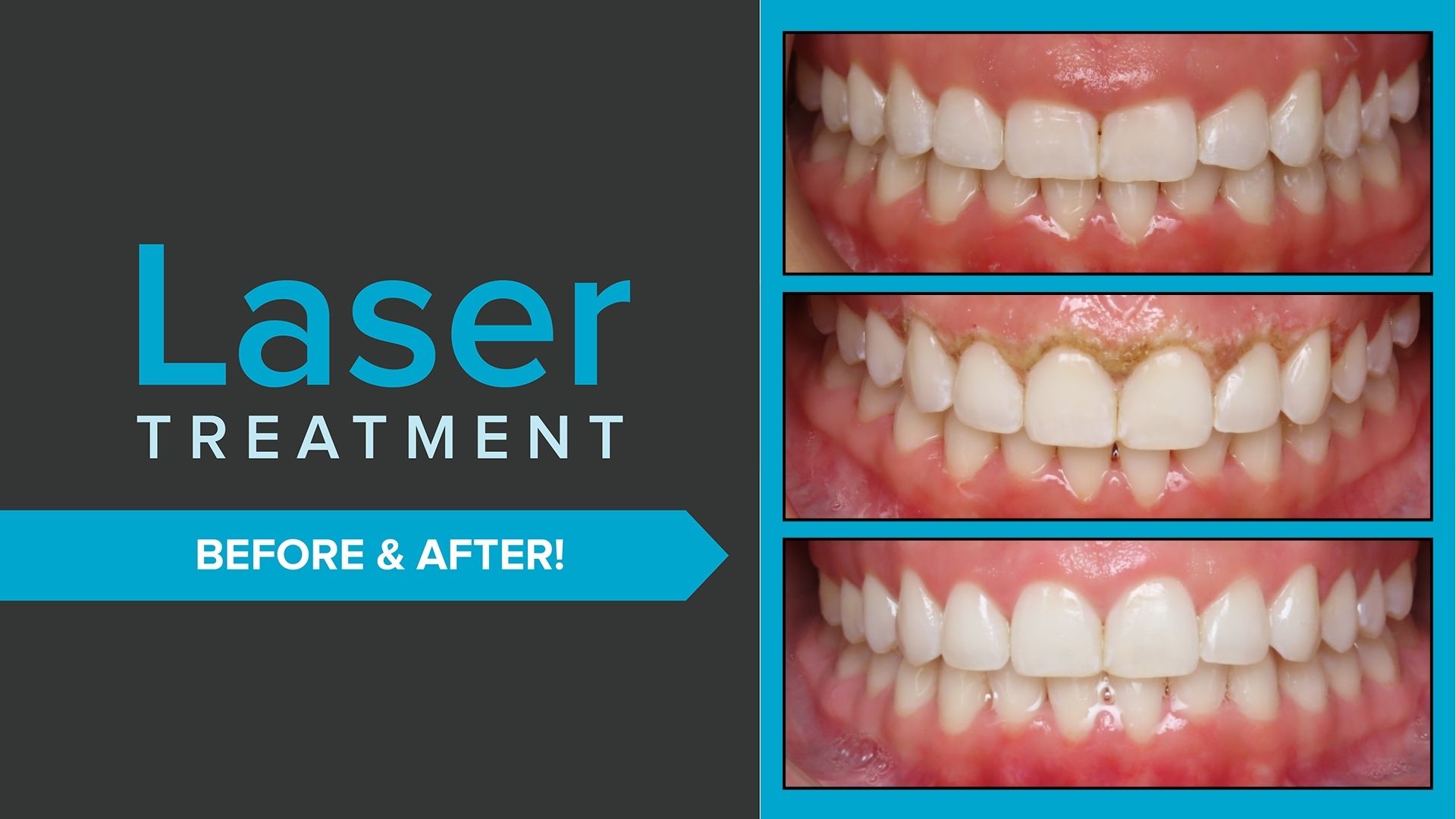 Grace Bernal Laser B4 After 1 1