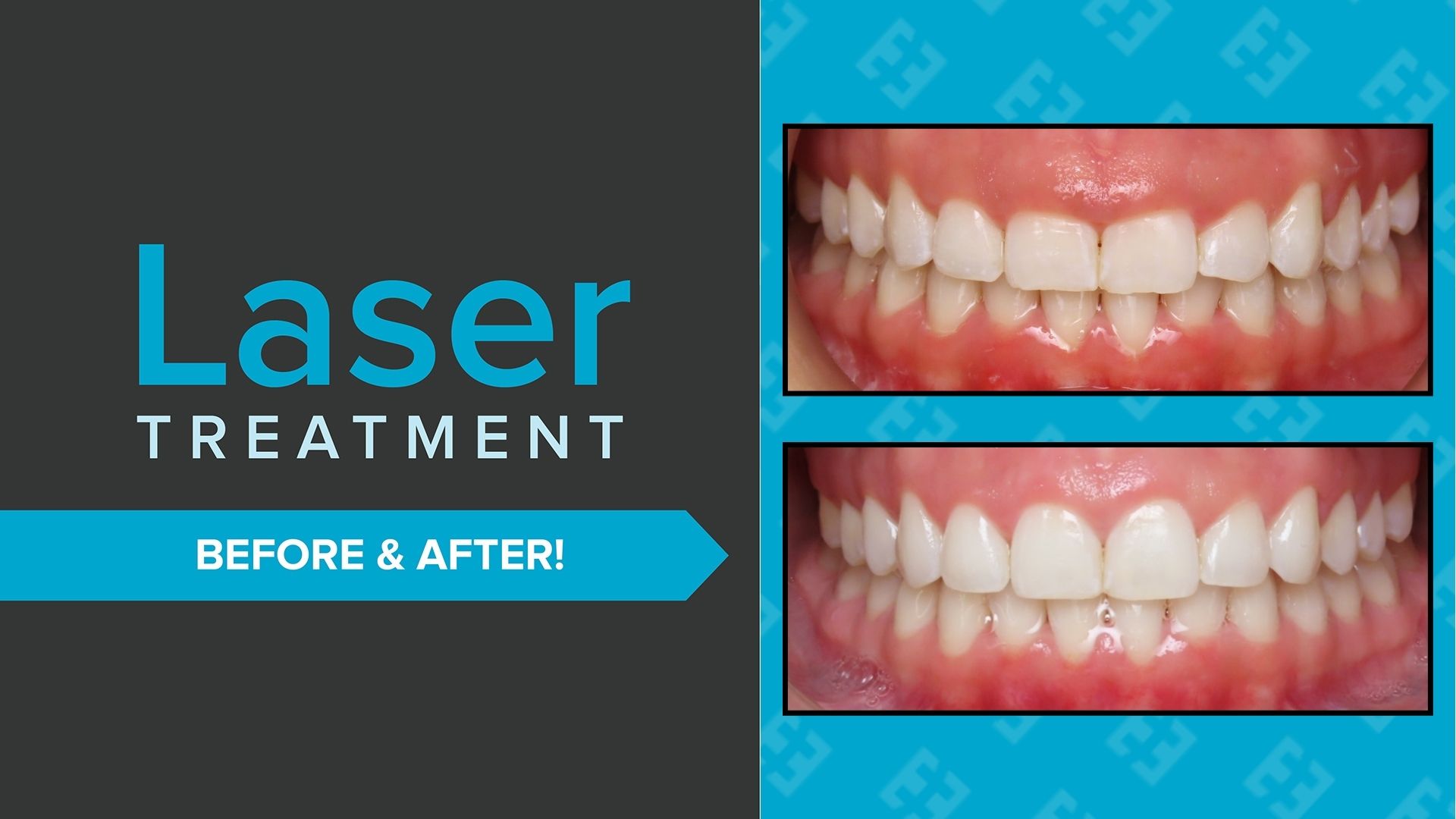 Grace Bernal Laser B4 After