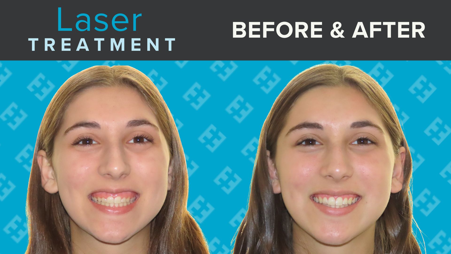 Krya Griess Laser Tx B4 After 1 1