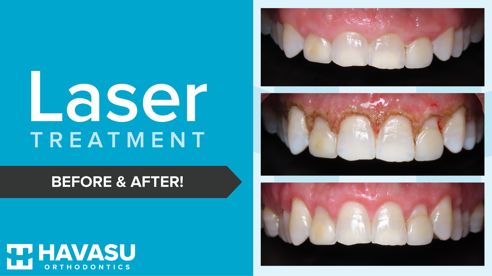 AOH Dr. Cain laser contrast updated