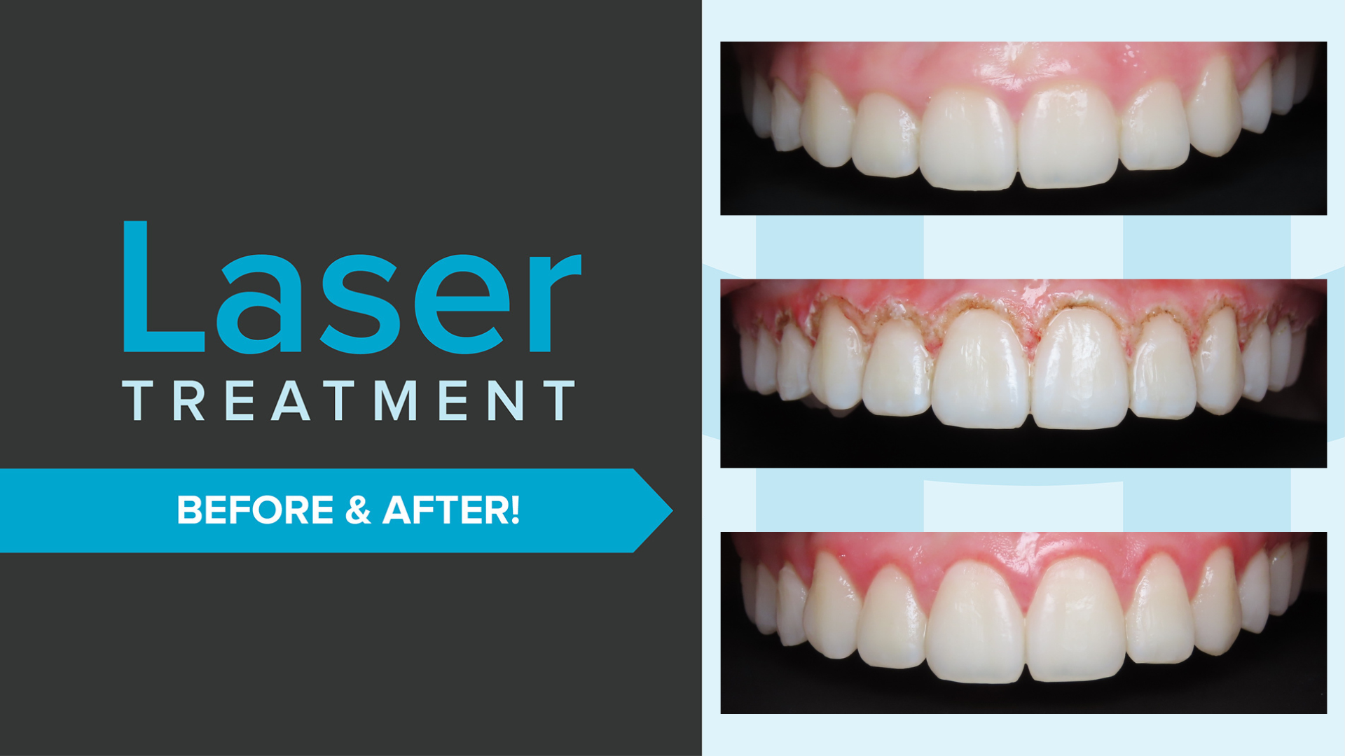 AOH Laser contrast updated