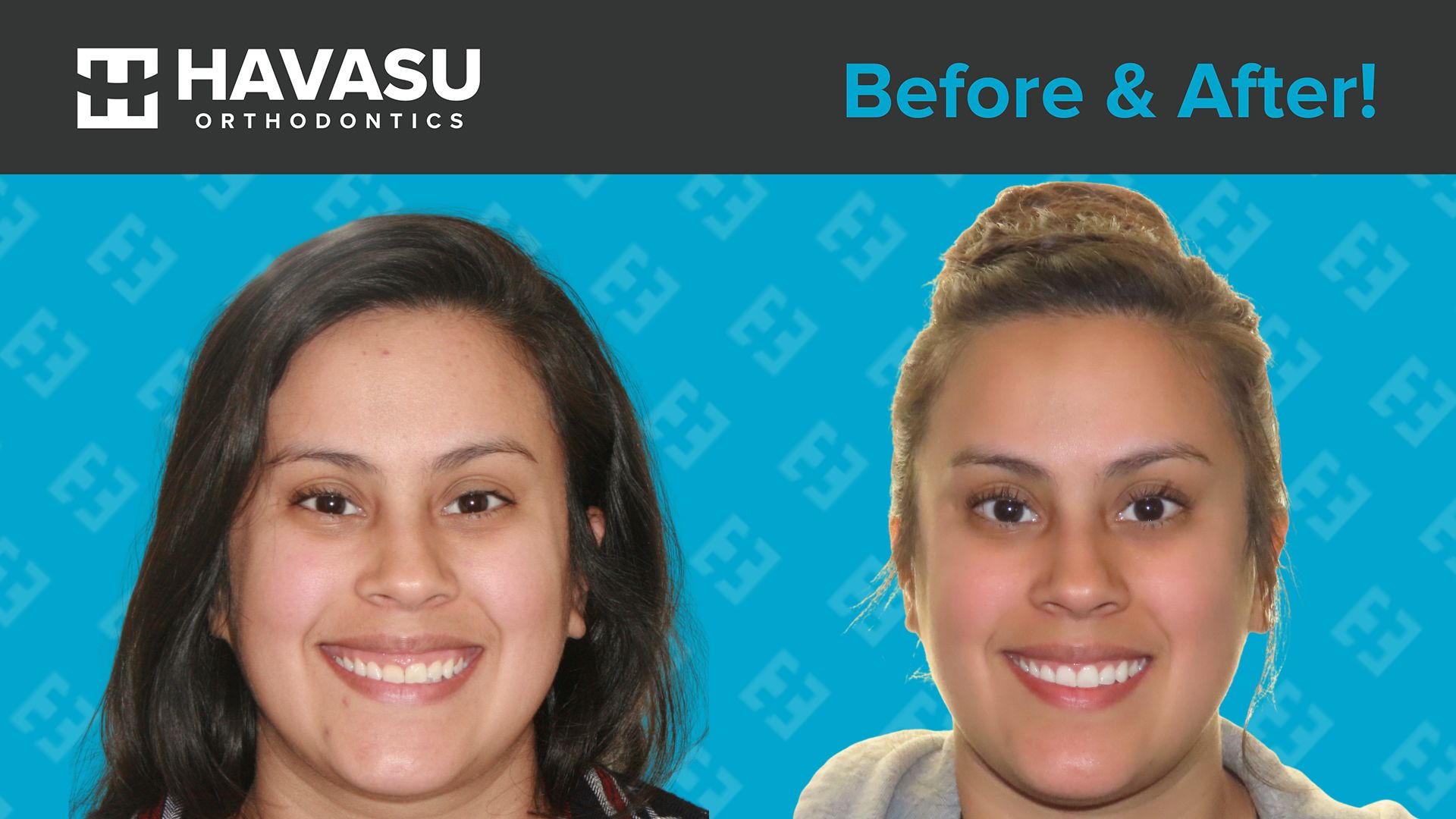 GraceBernalFacialBeforeAfter