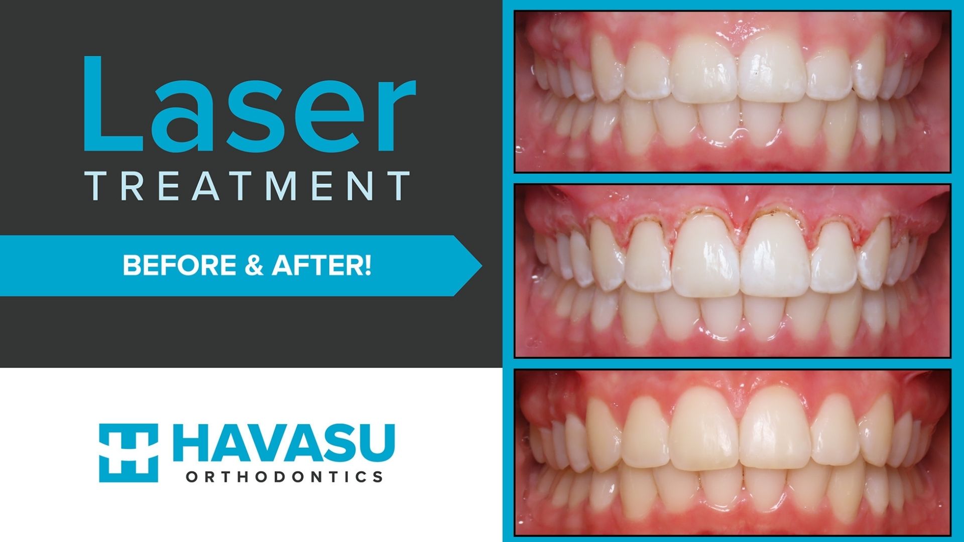 TaytumCrawleyLaserB4andAfter